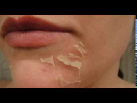 Почему шелушится кожа на лице, как избавиться от шелушения кожи