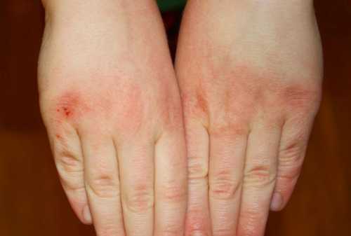 Наносить на кожу рук увлажняющие и питательные крема особенно после воздействия на нее внешних негативных факторов